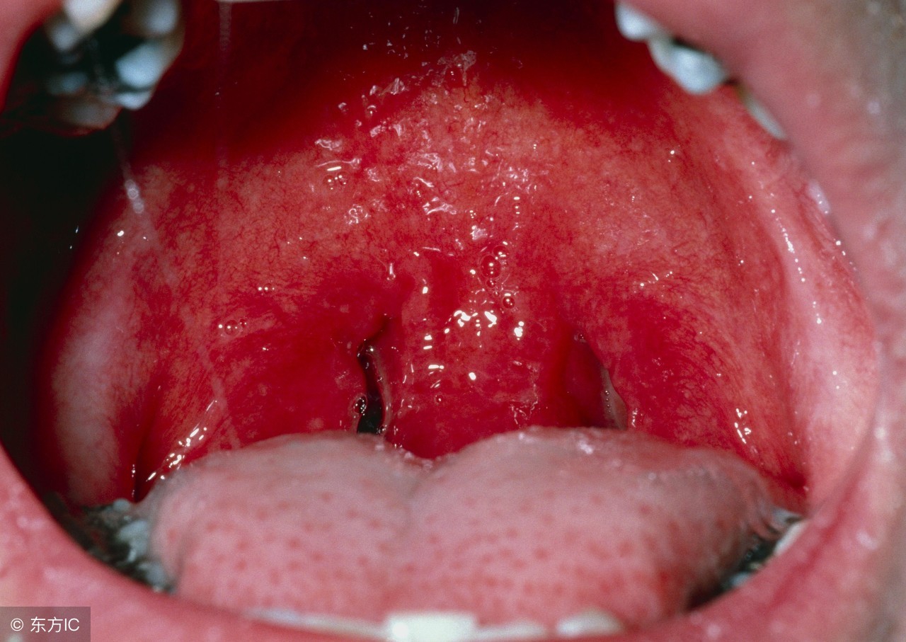 咽口水很难咽下去怎么解决,很容易咽喉炎怎么办