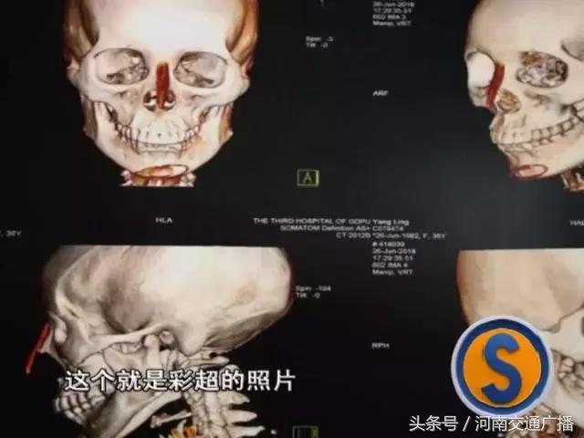 一女子因整容失败,一名女子整容失败