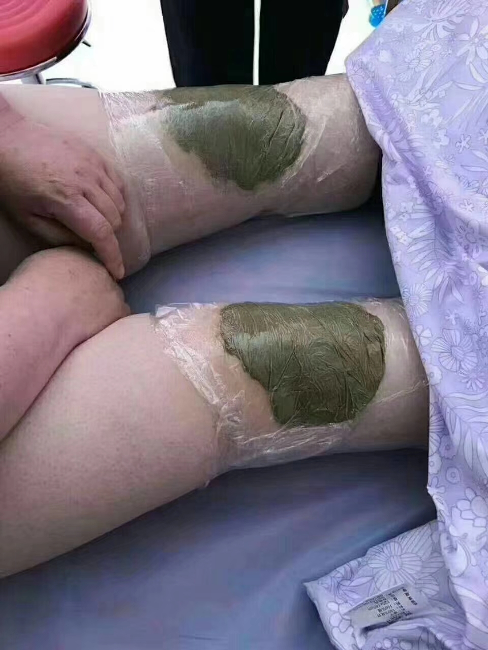 髌骨软骨软化的康复方法