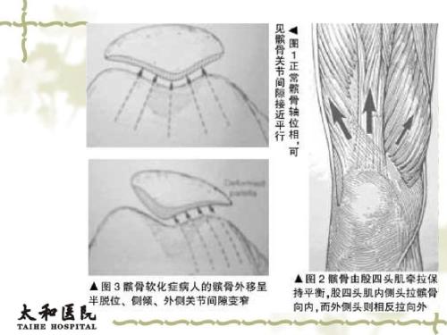 髌骨软骨软化的康复方法