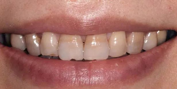 日本牙膏修复牙洞是真的吗,为什么日本人牙那么白