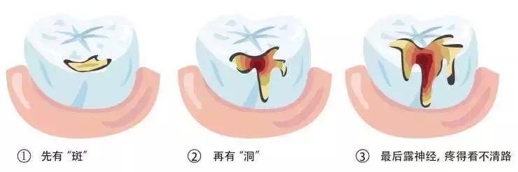 如何让你的蛀牙停止恶化三种方法,一招解决蛀牙的方法