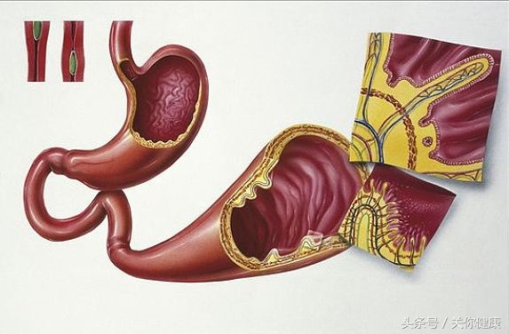 腹痛便血是缺血性结肠炎吗,结肠炎是间歇性的便血吗
