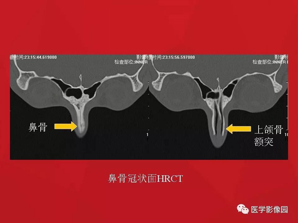左侧鼻骨骨折伴鼻中隔骨折,双侧鼻骨及左上颌骨突骨折