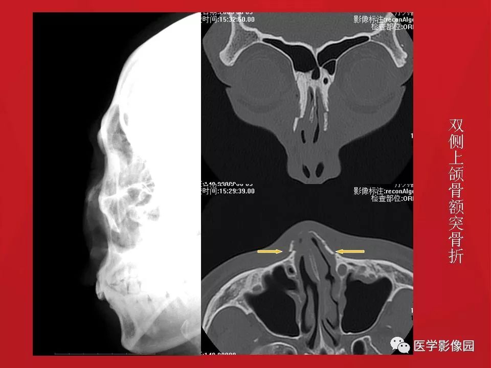 左侧鼻骨骨折伴鼻中隔骨折,双侧鼻骨及左上颌骨突骨折