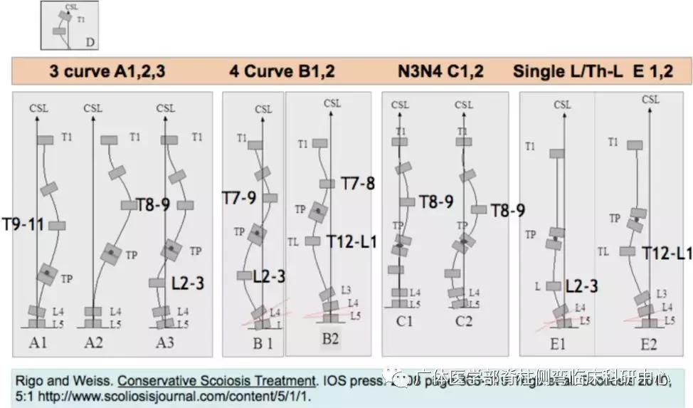 Scolioscan三维超声实现姿势矫正可视化（三）——近胸弯