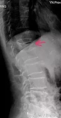 骨质疏松引起的老年性腰椎骨折,胸11椎体压缩性骨折怎么治疗