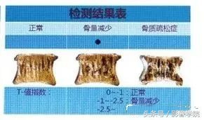 骨质疏松引起的老年性腰椎骨折,胸11椎体压缩性骨折怎么治疗