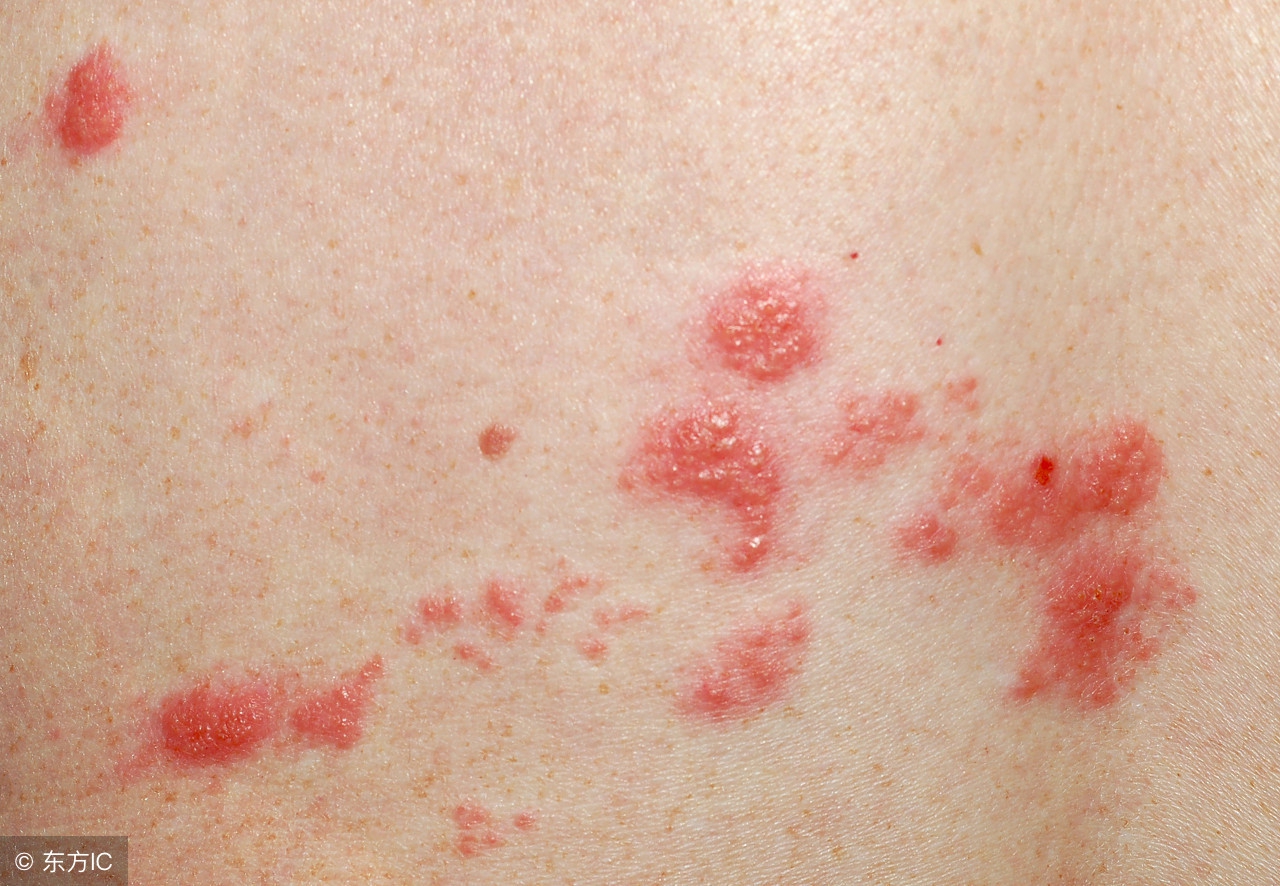带状疱疹注意什么，最大的痛苦是“瘙痒”