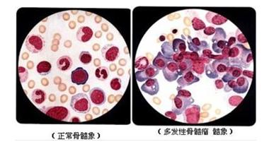 急性白血病和多发性骨髓瘤的区别 (多发性骨髓瘤 淋巴瘤 白血病区别)