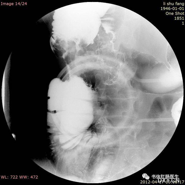10种经典肠道影像征象：绳征、串珠征、螺纹征……你听过几个？