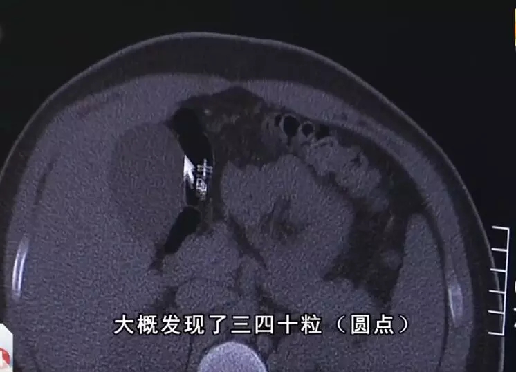 19岁男孩喝珍珠奶茶后腹痛,16岁男孩喝一杯珍珠奶茶窒息