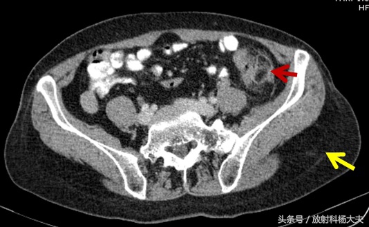 左侧小腹疼痛妇科b超检查没问题,右下腹疼痛妇科b超正常