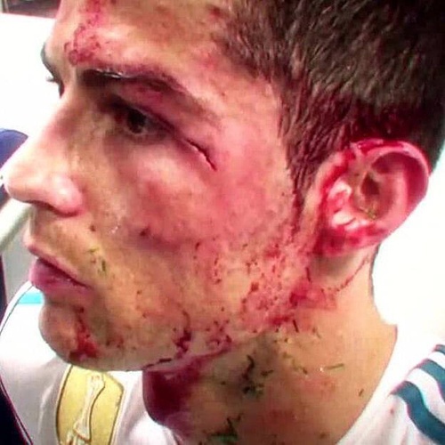 c罗受过最重的伤视频,c罗那些年欧冠