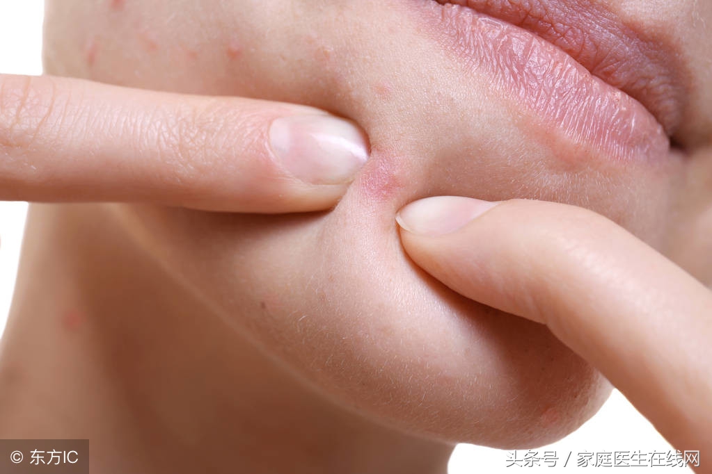 为什么有些人脸上长很多痘痘,为什么有的人脸部很容易长痘痘