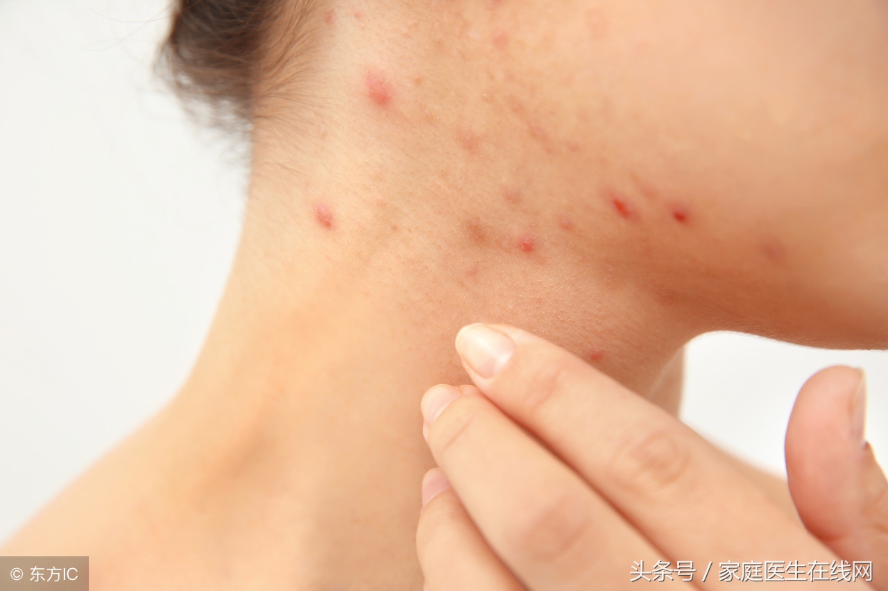 人脸上长痘痘是为什么怎么治,一般人脸上长痘痘是什么原因