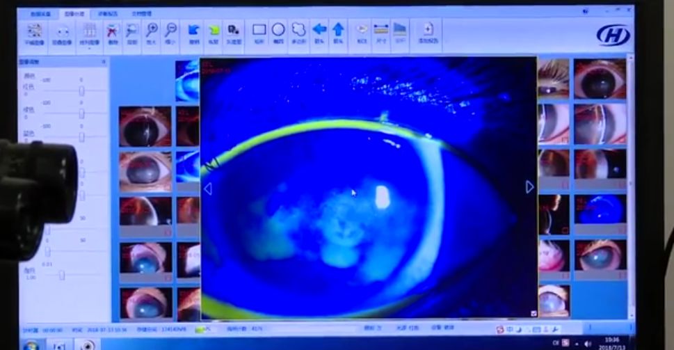 14岁女孩戴美瞳感染,14岁女孩戴美瞳可以吗