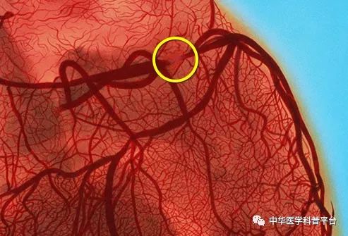 高血压停药的危害,高血压的危害视频