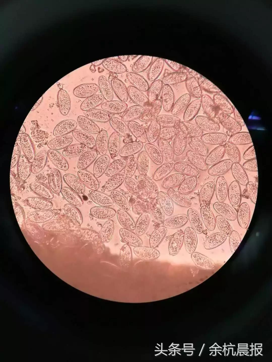 小孩有白色小虫,小孩有白色小虫子