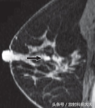 b超和钼靶检查肿瘤大小不一样,b超和钼靶肿块大小不一样