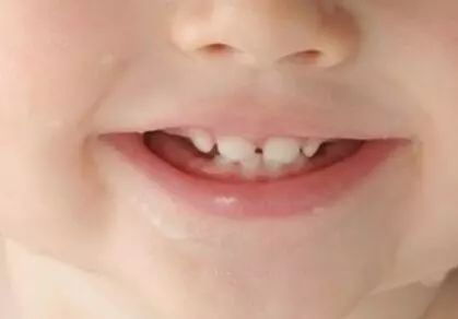 宝宝牙齿不好怎么修复,孩子牙齿异常怎么矫正