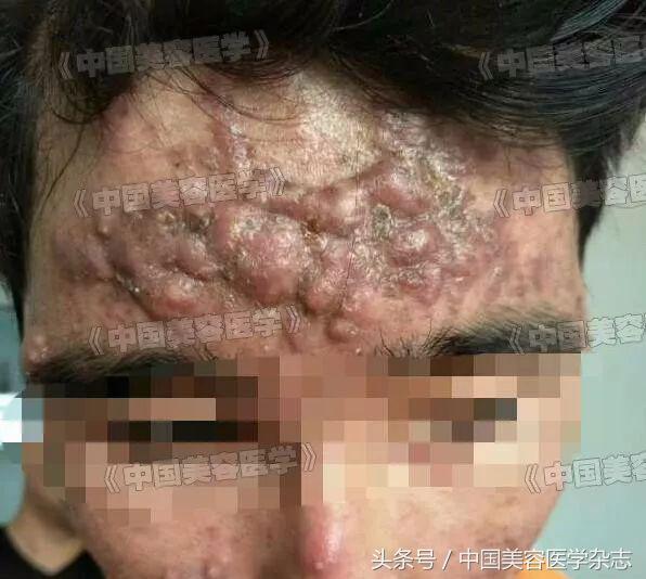 面部痤疮有什么危害,严重性痤疮要注意什么