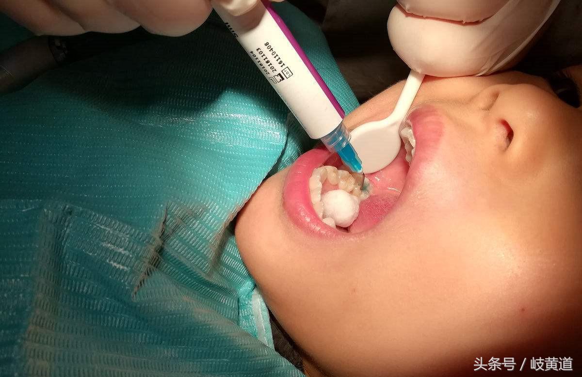 补完牙会更容易龋齿么,补完牙后更容易被龋坏吗