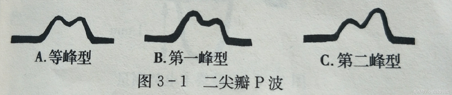 心房心室肥大,房室肥大要紧吗