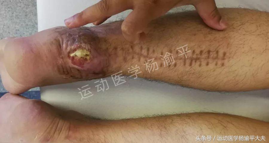 跟腱手术伤口为什么不好愈合,跟腱手术需要消肿才能手术吗