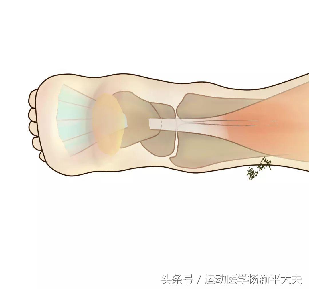 跟腱手术伤口为什么不好愈合,跟腱手术需要消肿才能手术吗