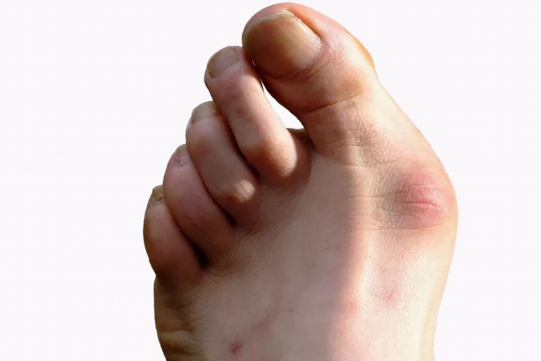 脚趾长肿瘤,女子脚趾长肿瘤竟是穿鞋不当引发