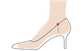 脚趾长肿瘤,女子脚趾长肿瘤竟是穿鞋不当引发