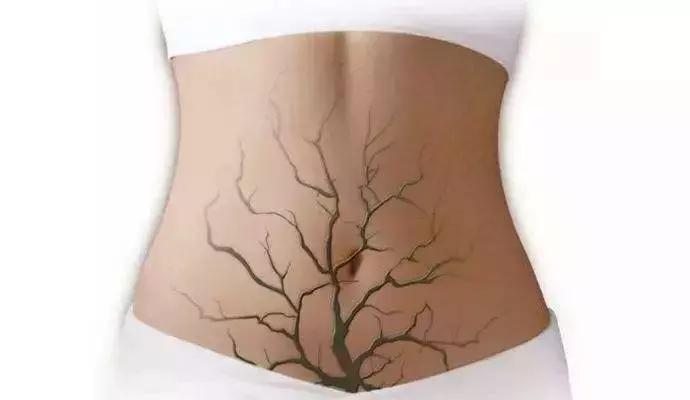 20岁子宫腺肌症能根治吗,子宫腺肌症能彻底根治吗