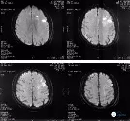 颈动脉闭塞介入治疗的风险,慢性动脉闭塞症病例