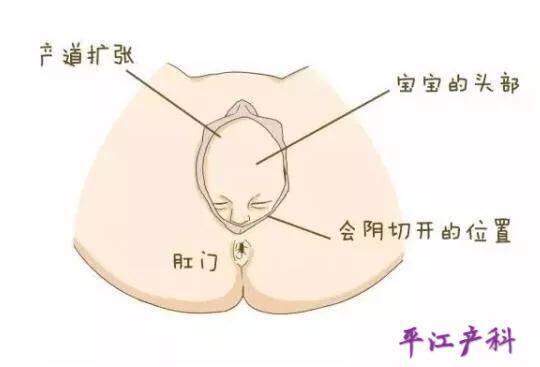 如何避免分娩时侧切,害怕顺产侧切怎么办