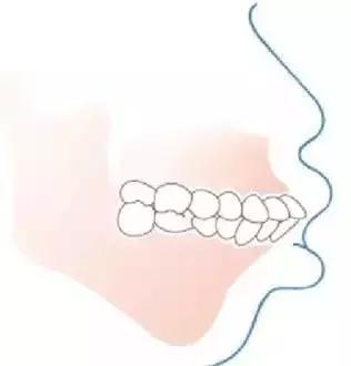 孩子刚刚换牙长歪了怎么补救,孩子换牙怎么才能确保不长歪