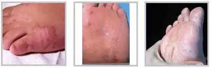 怎么拯救你,我的“大汗脚”……脚臭和脚气,有多远的距离?