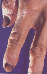 手上长小水泡感觉疼怎么回事夏天,夏天手上长小水泡脱皮是什么原因