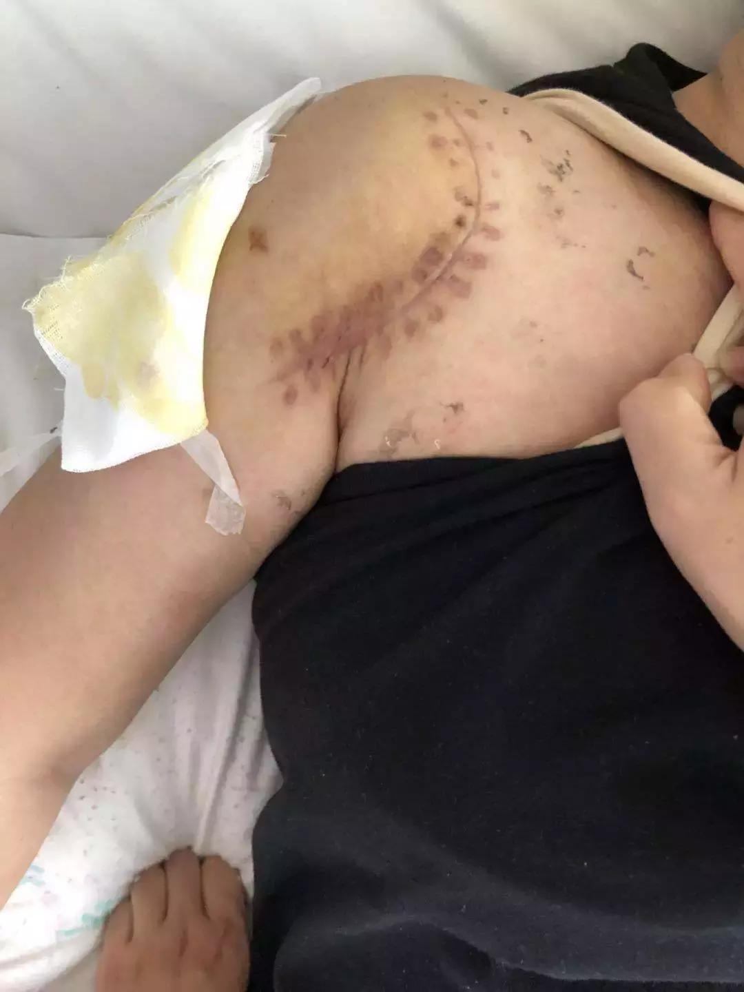 肩关节镜微创技术,徐州肩关节微创关节镜