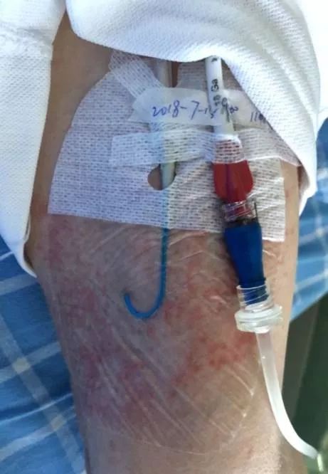 picc皮疹处理,picc湿疹的护理措施