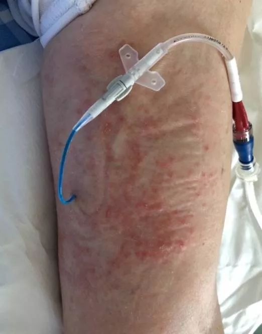 picc皮疹处理,picc湿疹的护理措施