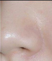 毛孔粗大如何治疗最好最快,如何治疗黑头和毛孔粗大