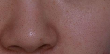 治疗毛孔粗大,激光治疗毛孔粗大多少钱