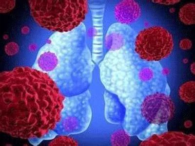 河南省肿瘤医院肺癌专家刘怀民,王启鸣小细胞肺癌