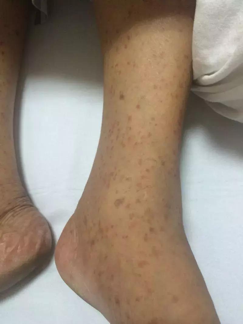 化疗后烂手烂脚怎么办,化疗手脚皮肤溃烂如何处理