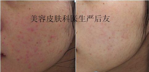 敏感性皮肤用什么化妆品好,敏感性皮肤的特征是什么