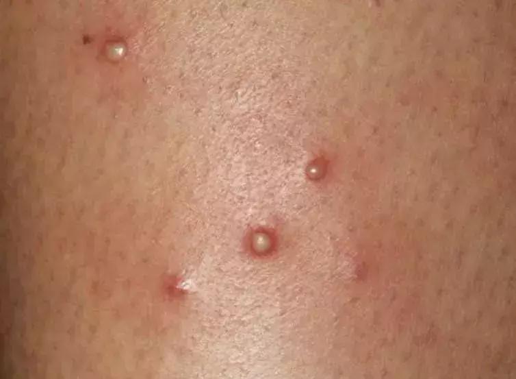 宝宝身上一大片的包是怎么回事,宝宝身上好多片包