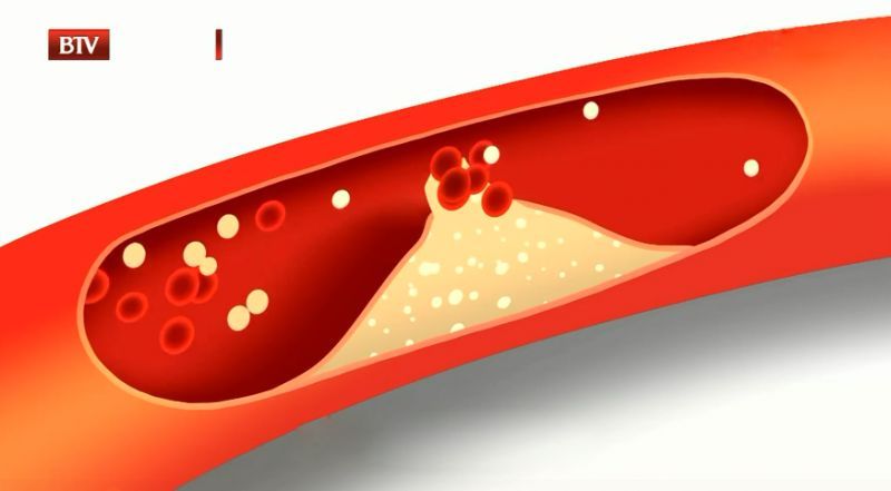 警惕血脂异常的3个信号,血脂异常的十大征兆