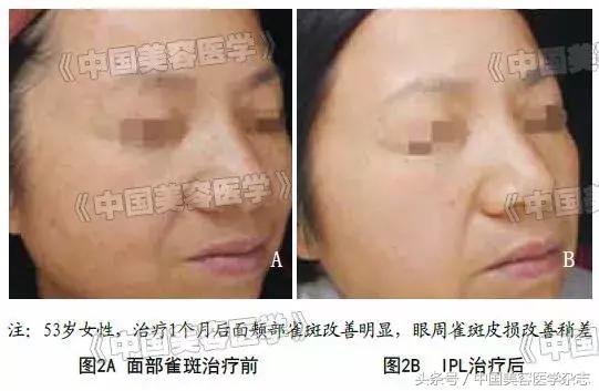 q开关激光祛斑效果,q开关激光祛斑怎么样