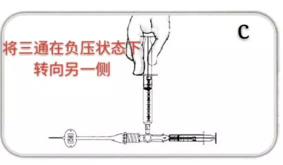 picc堵管用尿激酶剂量,picc堵管了如何用尿激酶通管